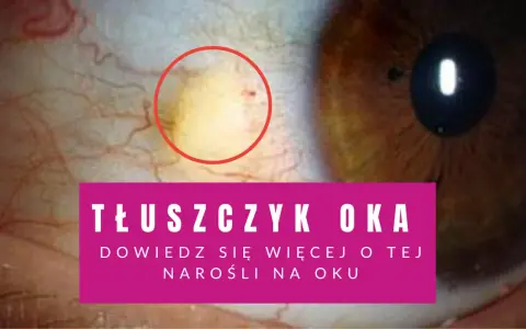 Widoczna biała plamka na białku oka, otoczona czerwonym okręgiem, to tłuszczyk. Dowiedz się więcej o tej narośli.