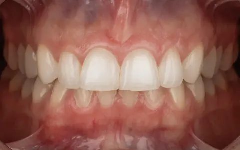 Zbliżenie na zdrowe zęby i dziąsła. Profesjonalna fotografia stomatologiczna ukazująca piękny uśmiech.