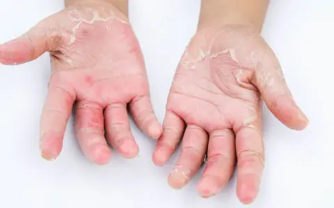 Mani con evidente desquamazione della pelle, arrossamento e secchezza. La pelle appare irritata e screpolata.