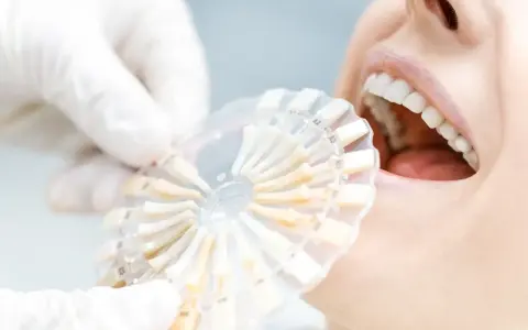 Usta pacjentki z białymi zębami, dentysta porównuje odcień zębów z paletą kolorów. Po wybielaniu zębów zalecana jest biała dieta.