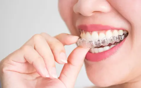 Kobieta z różowymi ustami zakłada przezroczysty aparat Invisalign na zęby.