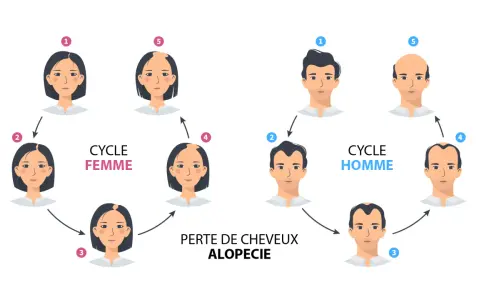 Illustration du cycle de la perte de cheveux, montrant l'alopécie chez la femme et l'homme.