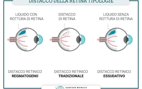 Illustrazione mostra tre tipi di distacco della retina: con rottura, tradizionale e essudativo. Il buco nella retina è evidenziato in uno dei casi.