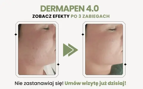 Dermapen 4.0 na co? Zobacz efekty po 3 zabiegach: skóra wygładzona, bez niedoskonałości. Umów wizytę!