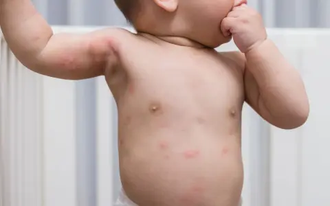 Un bébé a des rougeurs et des petits boutons sur le corps, notamment sur le torse et les bras.