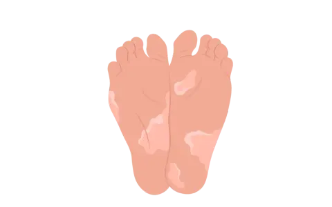 Pieds avec des zones dépigmentées, soulevant la question : pourquoi la peau de mes pieds s'enlève ?