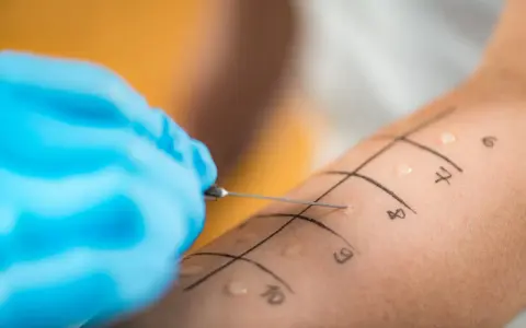Ręka z zaznaczonymi polami do testów alergicznych skórnych. Igła wprowadza alergen, rozpoczynając diagnostykę.