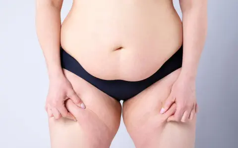 Persona se pellizca la piel de los muslos, mostrando la celulitis. Pensando en ejercicios abdomen bajo para mejorar.