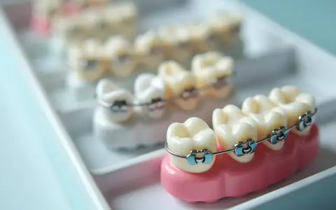 Modele zębów z aparatami ortodontycznymi w różnych kolorach, ułożone w białej tacce.
