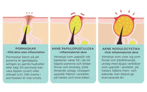 Illustrationer visar hur man vet om man har akne: pormaskar, inflammatorisk akne och svår inflammatorisk akne.