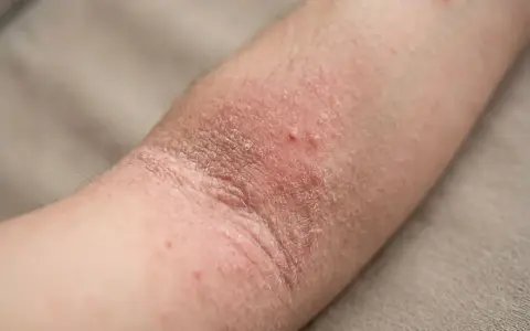 Bras atteint de dermatite atopique, avec peau rouge, sèche et squameuse, quelques petites vésicules.