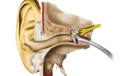 Coupe anatomique de l'oreille montrant les structures internes, y compris le tympan et les osselets, qui peuvent être affectés par une distorsion sonore oreille.