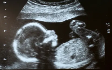 Ultraschallbild eines Babys, das sich im Mutterleib entwickelt. Ein kleiner Arm ist zu sehen, was auf einen ultraschall jungen hindeutet.