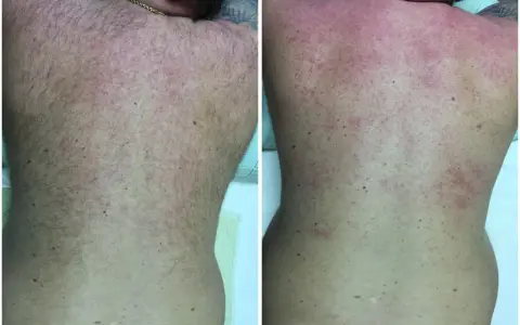 Comparación de la espalda antes y después de un intento de como depilarse la espalda uno mismo. La imagen de la derecha muestra irritación y enrojecimiento.