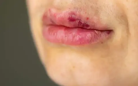 Usta z zaczerwienieniem i siniakami, możliwe kwas hialuronowy efekty uboczne po zabiegu.