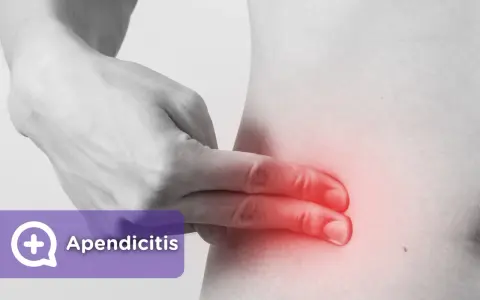 Apendicitis: ¿Dolor común o urgencia? Identifica los síntomas clave.