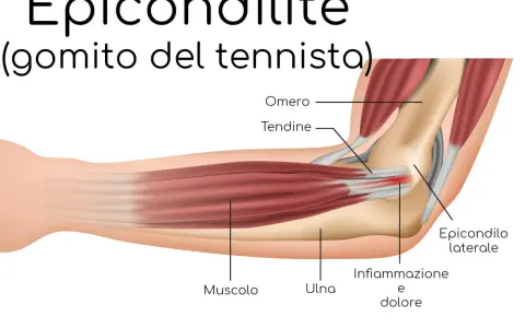 Illustrazione anatomica del gomito del tennista, evidenziando infiammazione e dolore all'epicondilo laterale.