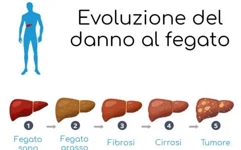 Evoluzione del danno epatico: da fegato sano a fegato grasso, poi fibrosi, cirrosi e infine tumore.