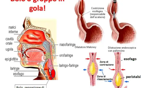 Illustrazione anatomica della gola e dell'esofago, che mostra come un bolo possa causare la sensazione di sentire qualcosa in gola.