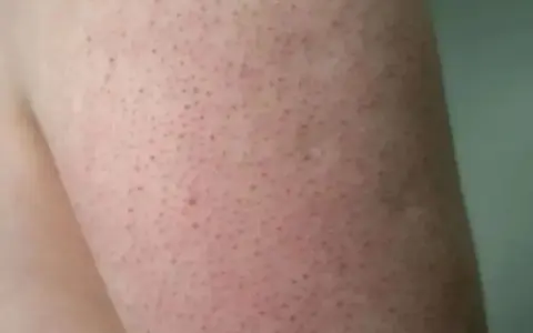Piel de fresa con pequeños puntos oscuros, como si fueran semillas, en un brazo.