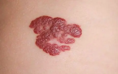 Ein roter, unregelmäßiger Hautfleck, der als mögliches Hautkrebs-Symptom betrachtet werden könnte.