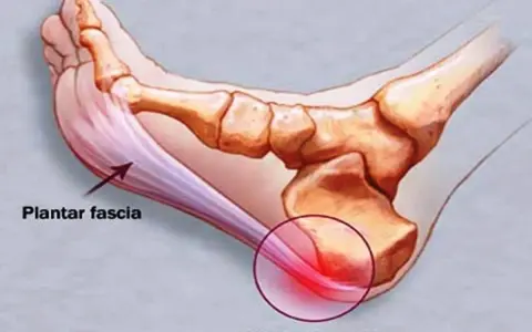 Illustration av fotens anatomi som visar plantar fascia och smärta vid plantar fasciitis.
