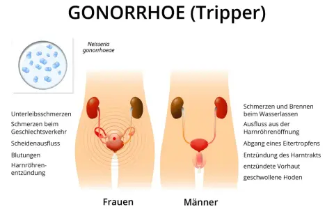 Darstellung von Gonorrhoe (Tripper) bei Frauen und Männern mit Symptomen wie Unterleibsschmerzen, Ausfluss und Entzündungen.