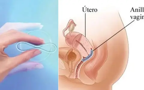 Anillo vaginal anticonceptivo en mano y su ubicación en el útero. No se debe quitar el anillo anticonceptivo durante relaciones.