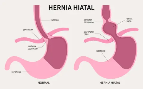 Hernia de hiato: Identifica sus síntomas y cuándo buscar ayuda.