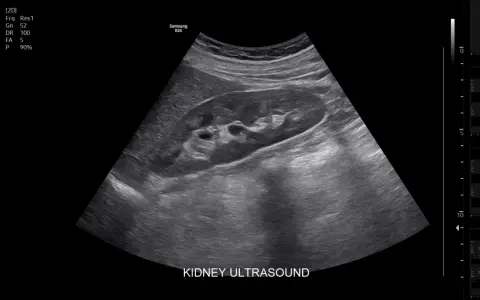 Obraz USG nerki. Czy usg jamy brzusznej wykryje raka? Badanie pokazuje strukturę nerki, pomagając w diagnostyce.