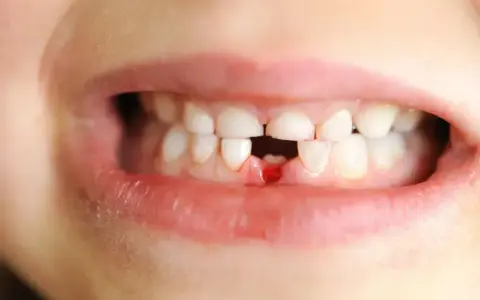 Wypadanie zębów mlecznych: objawy, kalendarz i kiedy do dentysty?