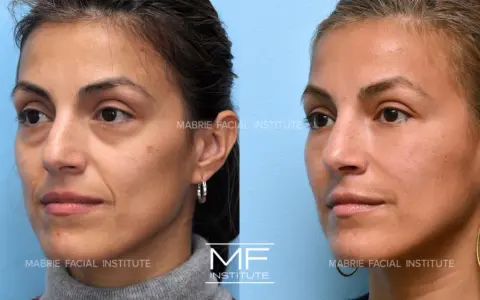 Before and after images show a woman's face, highlighting the reduction of nasolabial folds after a facial massage.