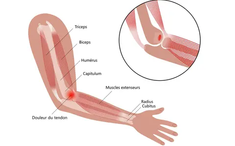 Illustration anatomique montrant une tendinite à l'intérieur du coude, avec douleur au tendon des muscles extenseurs.