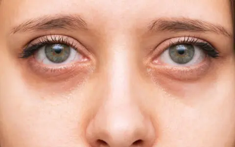 Primer plano de unos ojos con ojeras marcadas. Consejos para como quitar ojeras y lucir una mirada más descansada.