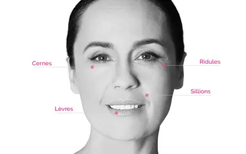 Visage marqué par des rides et cernes. Des points indiquent les zones d'application pour un avis sur l'acide hyaluronique.