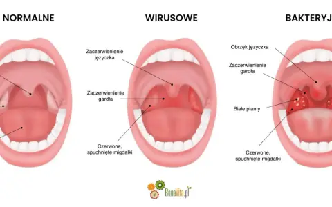 Porównanie gardła: normalne, wirusowe i bakteryjne. Ropna angina objawia się białymi plamami na czerwonych, spuchniętych migdałkach.