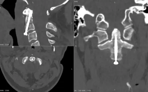 Widok CT kręgosłupa szyjnego po operacji. Widoczny implant stabilizujący, śruba przechodzi przez ząb obrotnika.