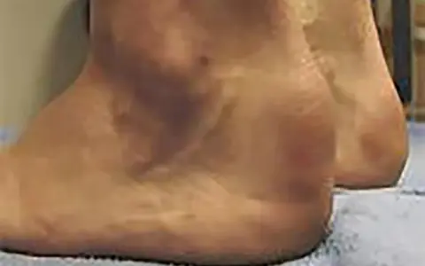 Gros plan sur un talon, suggérant une tendinite du tendon d'Achille. La peau semble légèrement rougie par endroits.