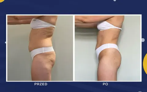 Liposukcja: Modelowanie sylwetki czy odchudzanie? Poznaj prawdę