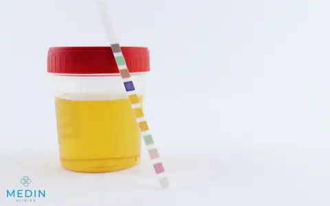 Pojemnik z żółtym płynem i paskiem testowym do analizy moczu. Kolory na pasku mogą wskazywać na różne parametry, w tym na ciemny mocz.