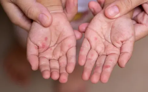 Dłonie dziecka z czerwonymi kropkami, objawem bostonki. Zmartwiona mama martwi się o zdrowie malucha, zwłaszcza w kontekście ciąży.