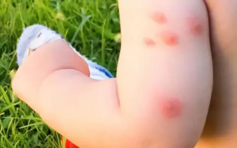 Bebé con varias picaduras de mosquito rojas e inflamadas en su brazo, jugando en el césped.