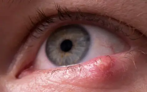 Gros plan sur un œil avec une tache rouge sur la paupière supérieure, près des cils.