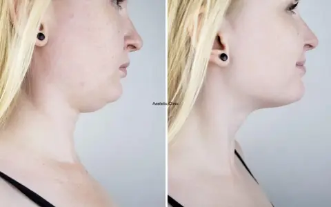 Przed i po zabiegu: widoczna redukcja podwójnego podbródka dzięki lipolizie. Efekty lipolizy podbródka są spektakularne.