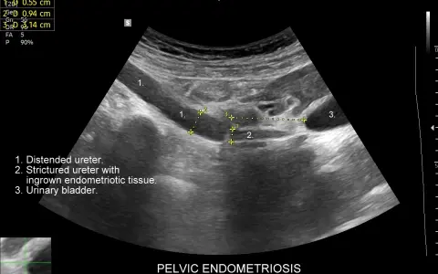 USG miednicy: poszerzony i zwężony moczowód z tkanką endometrialną, pęcherz moczowy.
