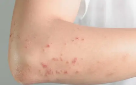 Skóra ramienia z licznymi zaczerwienionymi, swędzącymi zmianami, które mogą być objawami nietolerancji histaminy.