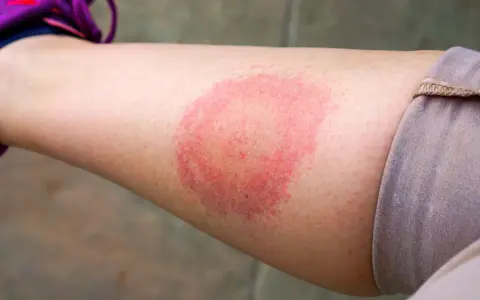 Borrelien Symptome beim Menschen: Warnzeichen, die Sie nicht ignorieren sollten