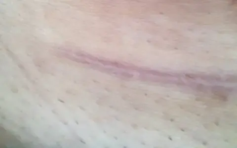 Widoczna blizna na szyi po operacji, lekko różowa, z drobnymi włoskami na skórze.