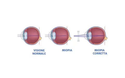 Diagrammi oculari mostrano visione normale, miopia e miopia corretta. I sintomi della miopia degenerativa sono visibili nel secondo occhio.