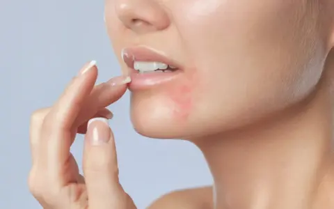 Une femme touche sa bouche, présentant une rougeur autour des lèvres, symptôme de dermatite periorale.